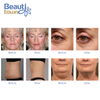 hifu facelift machine cost new generation face lifting and tightening