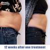 How Much Does A Trusculpt Machine Cost